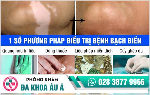 khám bạch biến