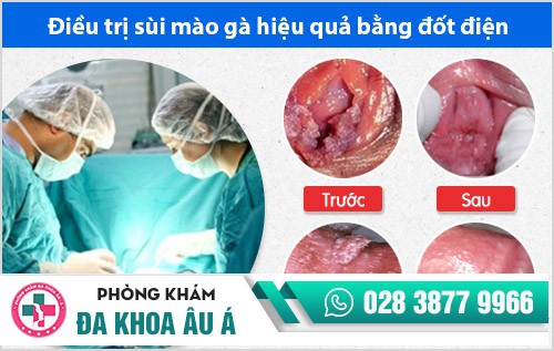 Các giai đoạn sùi mào gà và biểu hiện cụ thể
