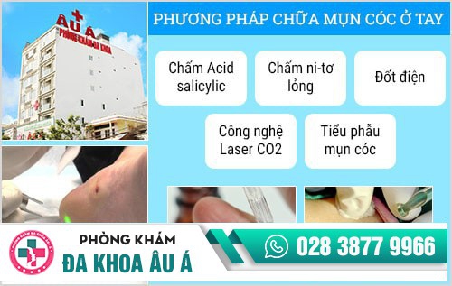 mụn cóc ở tay