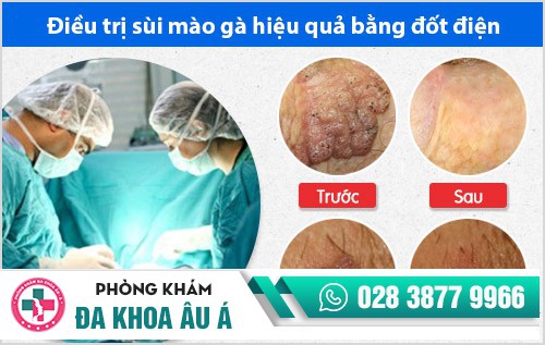 Hỗ trợ điều trị sùi mào gà hiệu quả với phương pháp đốt điện cải tiến mới
