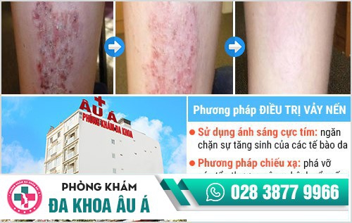 Bệnh vảy nến và những thông tin cần biết
