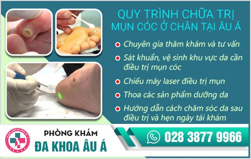 QUY TRÌNH CHỮA MỤN CÓC Ở CHÂN TẠI DA LIỄU ÂU Á