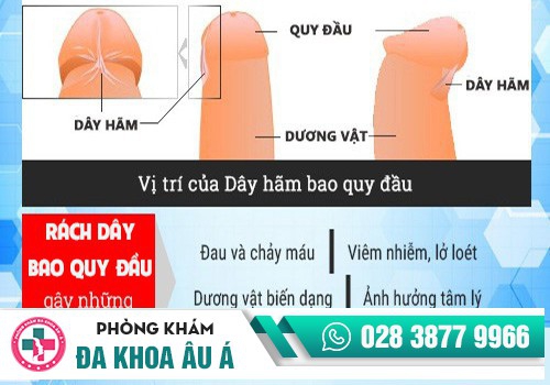 RÁCH BAO QUY ĐẦU CÓ NGUY HIỂM KHÔNG?