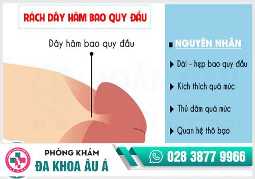 Các nguyên nhân gây rách dây hãm bao quy đầu