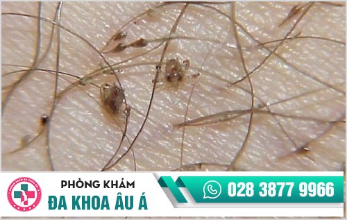 Thuốc trị rận mu loại nào tốt và hiệu quả nhất?