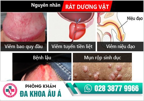 Rát dương vật là dấu hiệu nhiều bệnh nguy hiểm