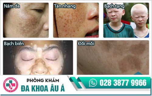cách trị rối loạn sắc tố da