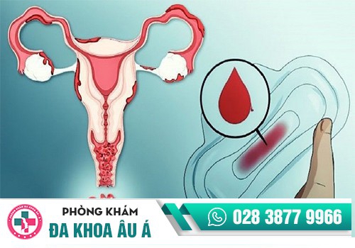 KHÔNG CÓ KINH NGUYỆT LÀ BỊ LÀM SAO? CÓ NGUY HIỂM KHÔNG?