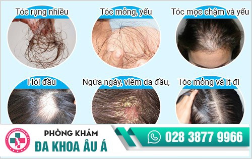 Biểu hiện rụng tóc nam, nữ