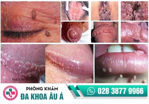 Khi nào cần xét nghiệm sùi mào gà?