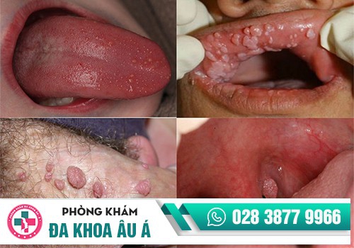 test nhanh sùi mào gà