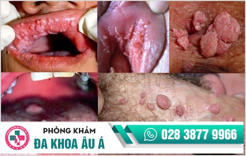 Những bệnh hoa liễu nguy hiểm và địa chỉ chuyên khám chữa