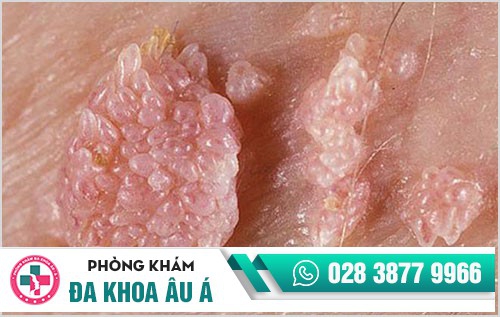 đốt sùi mào gà có trị sùi mào gà được không