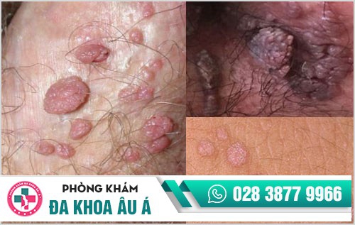 Hỗ trợ điều trị sùi mào gà hiệu quả với phương pháp đốt điện cải tiến mới