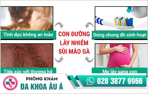  Sùi mào gà có lây hay không?