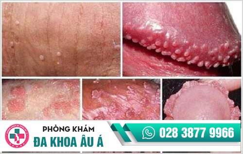 Sùi mào gà dương vật – bệnh nguy hiểm, khó đề phòng