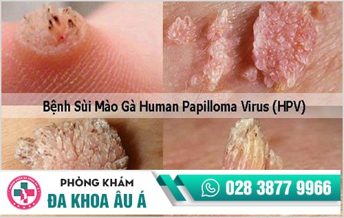 Bệnh hoa liễu là bệnh gì?