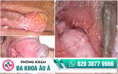 Bệnh sùi mào gà nguy hiểm như thế nào?