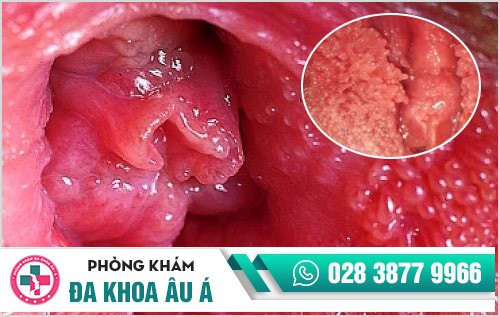 sùi mào gà ở âm đạo