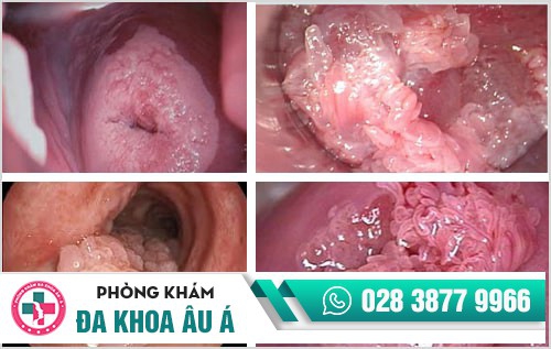 sùi mào gà ở âm đạo