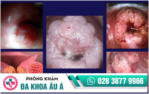 sùi mào gà ở cổ tử cung