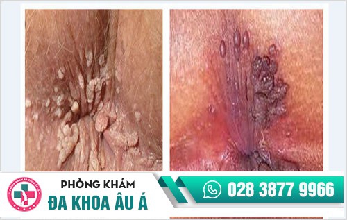 Bệnh sùi mào gà, căn bệnh dễ lây nhiễm nhưng khó điều trị