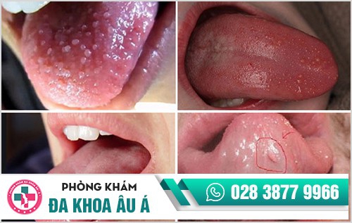 Sùi mào gà ở lưỡi