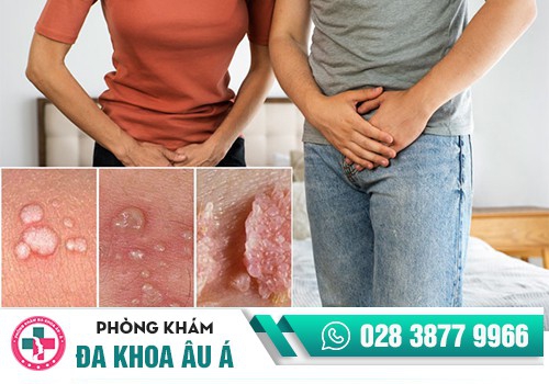   Xét nghiệm sùi mào gà bằng phương pháp type HPV - PCR