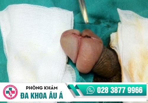 Sưng dương vật và nhiều nguy hiểm tiềm ẩn