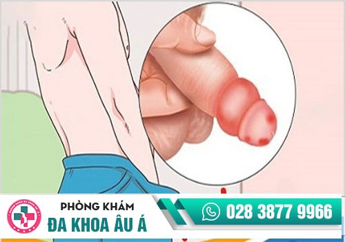 Đầu dương vật bị sưng