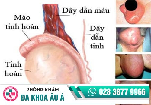 Sưng tinh hoàn bên phải