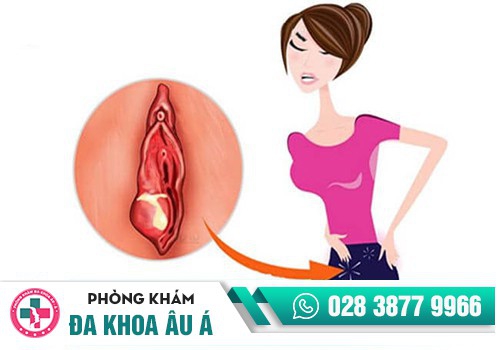Vùng kín bị sưng 1 bên mép là bệnh gì?