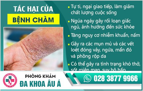 chữa bệnh chàm