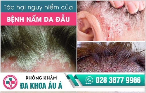 Nấm da đầu nguy hiểm như thế nào?