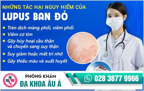 lupus ban đỏ