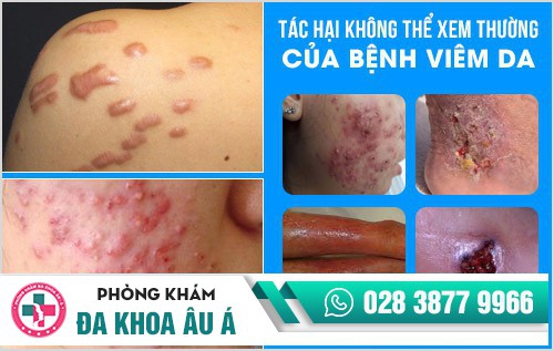 Địa chỉ chữa bệnh viêm da uy tín tại TP.HCM