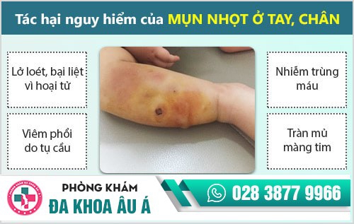 Dấu hiệu bị mụn nhọt tay, chân