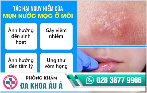 mụn nước ở môi