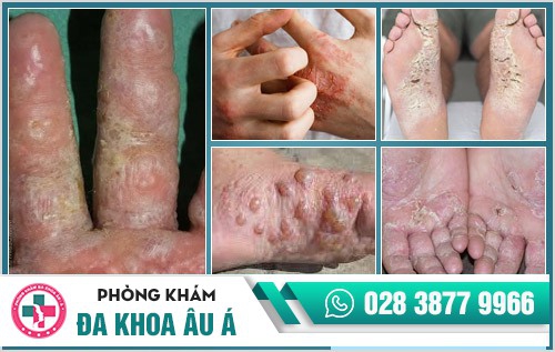 Cảnh báo các tác hại nguy hiểm của nấm da chân, da tay
