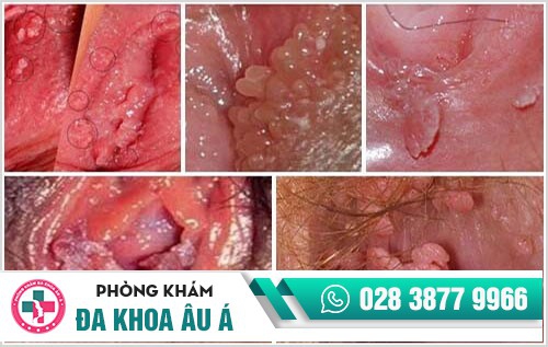 Các giai đoạn sùi mào gà và biểu hiện cụ thể