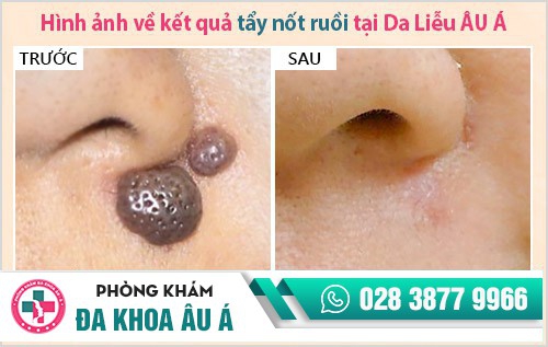 địa chỉ phá nốt ruồi