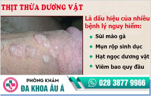 Nam giới cần cảnh giác với thịt thừa dương vật