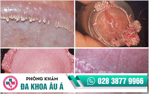 Nam giới cần cảnh giác với thịt thừa dương vật