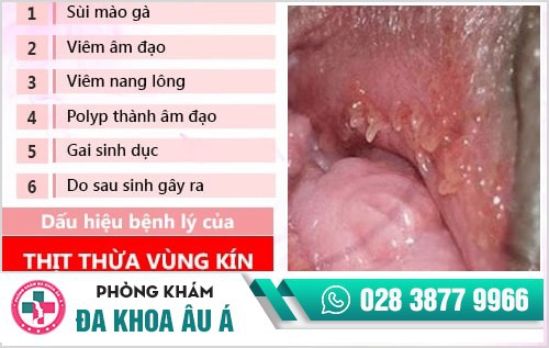 Những gì bạn không biết về thịt thừa vùng kín