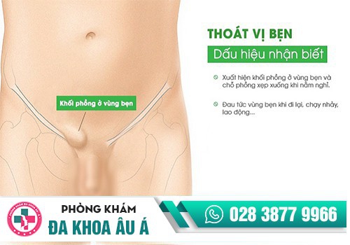 Thoát vị bẹn