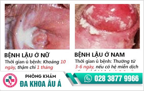 thời gian ủ bệnh lậu