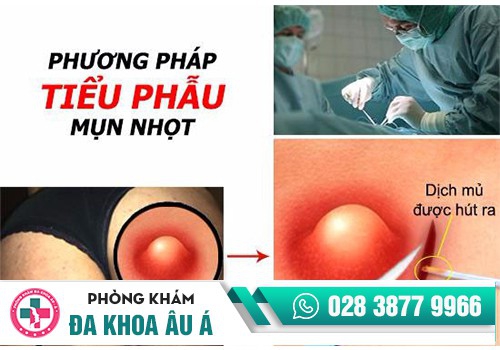 Tiểu phẫu mụn nhọt bằng công nghệ tiên tiến