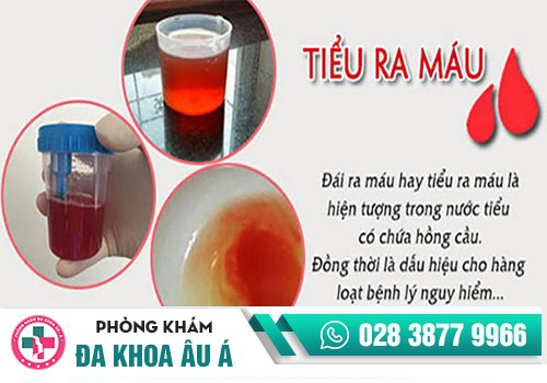 NGUYÊN NHÂN GÂY TIỂU RA MÁU ĐỀU LÀ NHỮNG BỆNH LÝ NGUY HIỂM
