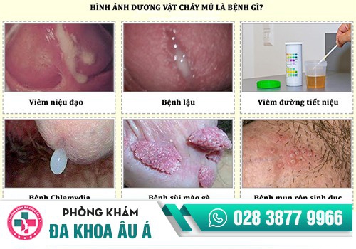 Đi đái ra mủ là bị bệnh gì?