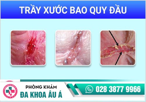 Trầy xước bao quy đầu